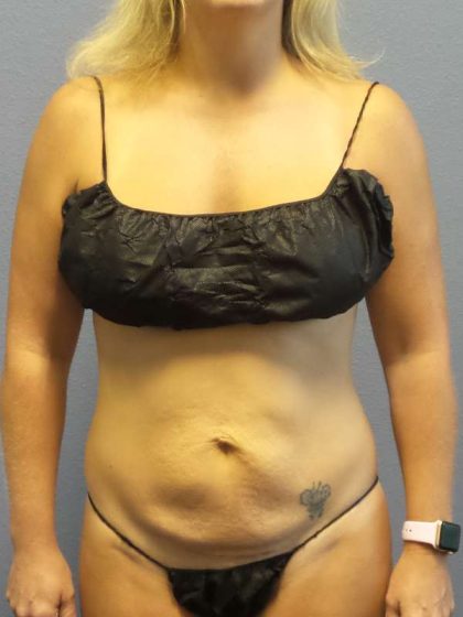 Abdominoplasty Before & After Patient #3177
