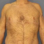Male Liposuction Before & After Patient #8248