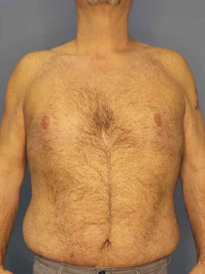 Male Liposuction Before & After Patient #8248