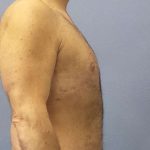 Male Liposuction Before & After Patient #8248