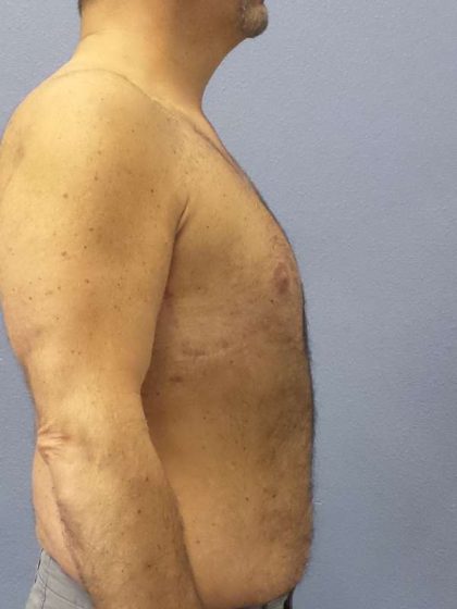 Male Liposuction Before & After Patient #8248