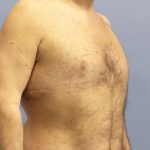 Male Liposuction Before & After Patient #8248
