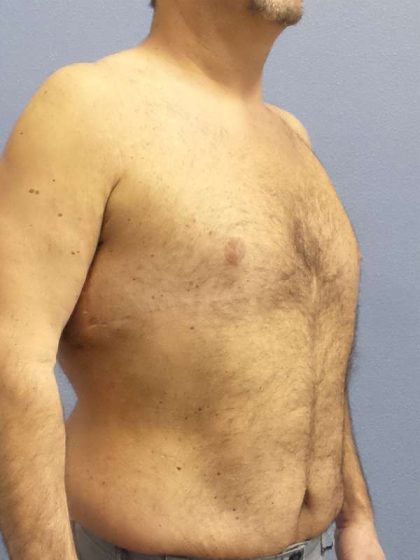 Male Liposuction Before & After Patient #8248