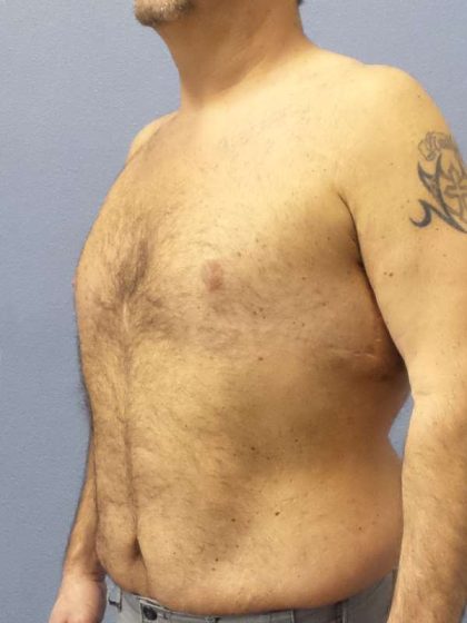 Male Liposuction Before & After Patient #8248