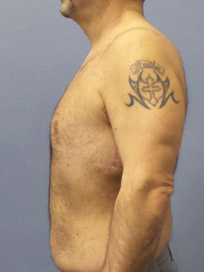 Male Liposuction Before & After Patient #8248
