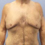 Male Liposuction Before & After Patient #8248