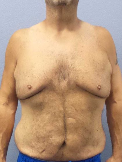 Male Liposuction Before & After Patient #8248