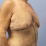 Male Liposuction Before & After Patient #8248