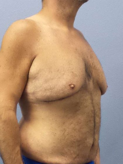 Male Liposuction Before & After Patient #8248