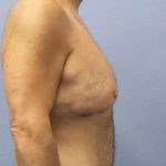 Male Liposuction Before & After Patient #8248