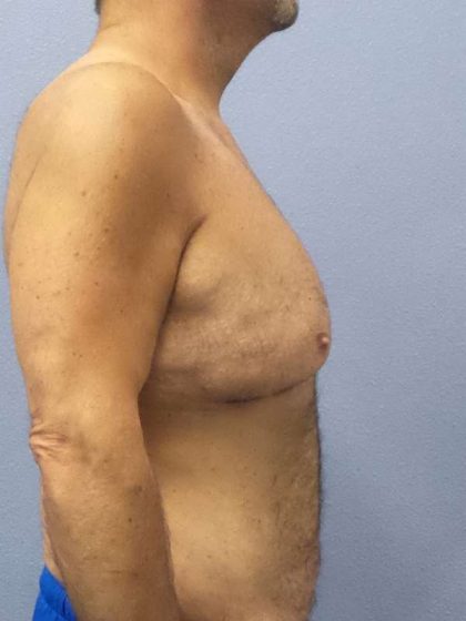 Male Liposuction Before & After Patient #8248