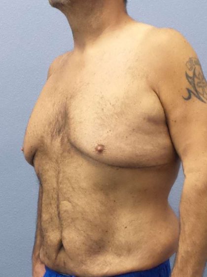 Male Liposuction Before & After Patient #8248