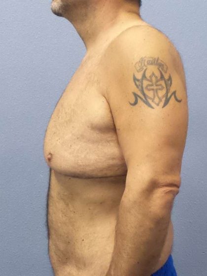 Male Liposuction Before & After Patient #8248