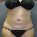 Liposuction Female Before & After Patient #11985