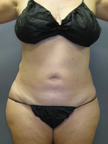 Liposuction Female Before & After Patient #11985