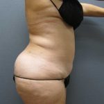 Liposuction Female Before & After Patient #11985