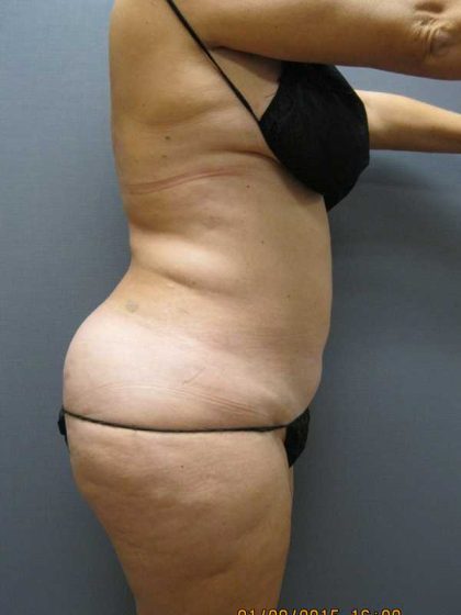 Liposuction Female Before & After Patient #11985