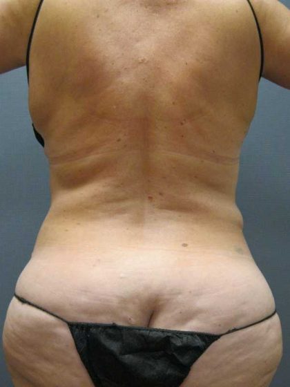 Liposuction Female Before & After Patient #11985