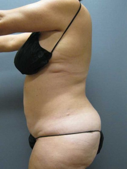Liposuction Female Before & After Patient #11985