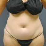 Liposuction Female Before & After Patient #11985