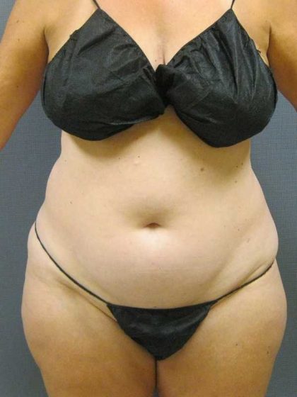 Liposuction Female Before & After Patient #11985