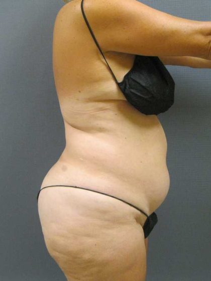 Liposuction Female Before & After Patient #11985
