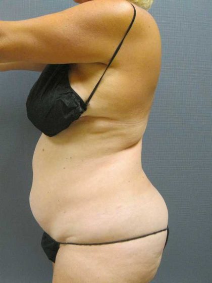 Liposuction Female Before & After Patient #11985