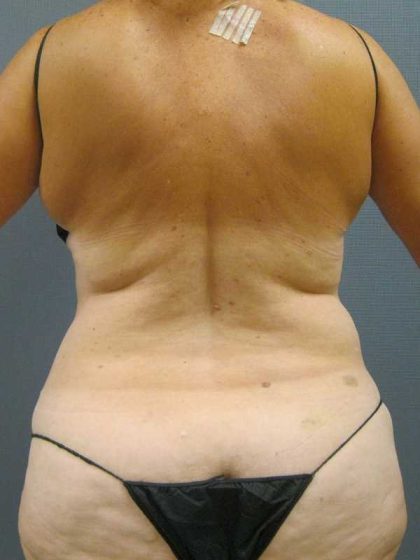Liposuction Female Before & After Patient #11985