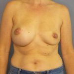 Breast Augmentation Revision (Breast Enlargement Repair) Before & After Patient #7223
