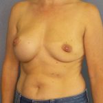Breast Augmentation Revision (Breast Enlargement Repair) Before & After Patient #7223