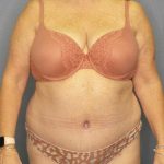 Abdominoplasty Before & After Patient #3482