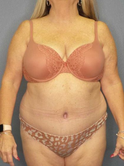 Abdominoplasty Before & After Patient #3482