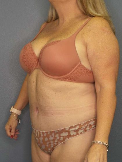 Abdominoplasty Before & After Patient #3482