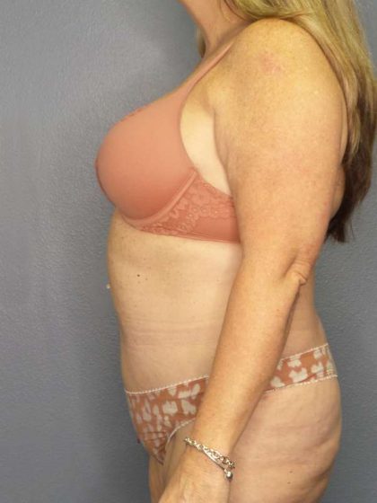 Abdominoplasty Before & After Patient #3482