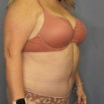 Abdominoplasty Before & After Patient #3482