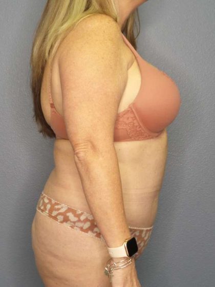Abdominoplasty Before & After Patient #3482
