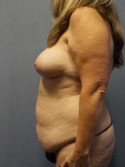 Abdominoplasty Before & After Patient #3482