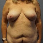 Abdominoplasty Before & After Patient #3482
