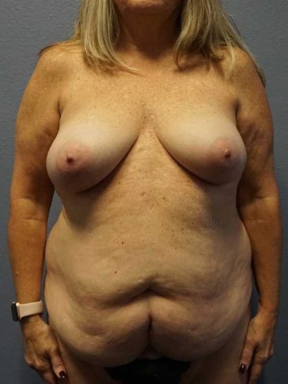 Abdominoplasty Before & After Patient #3482