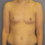 Breast Augmentation Before & After Patient #4925