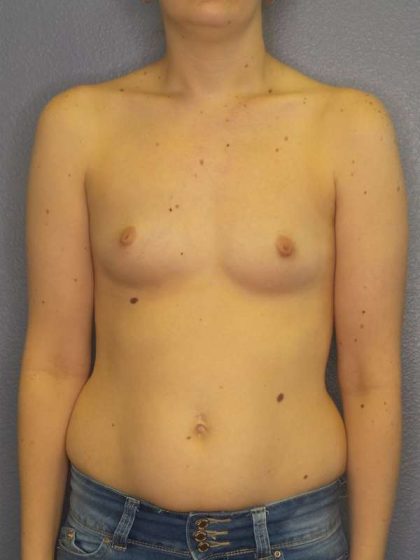 Breast Augmentation Before & After Patient #4925