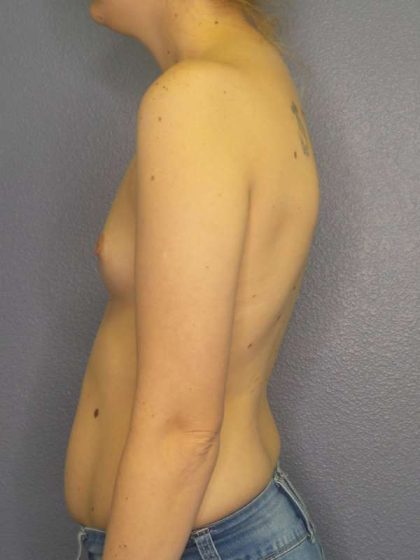 Breast Augmentation Before & After Patient #4925