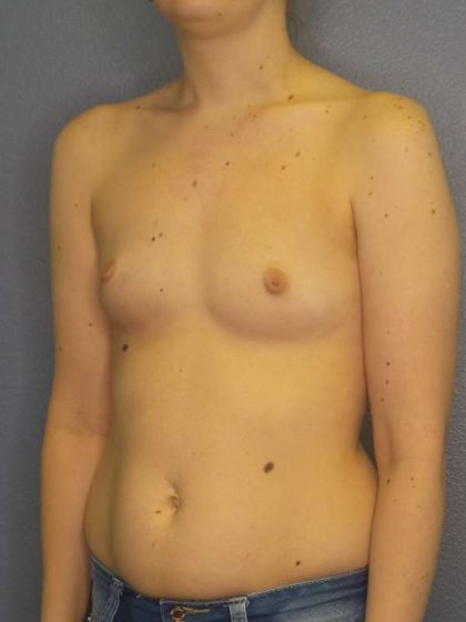 Breast Augmentation Before & After Patient #4925