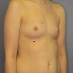Breast Augmentation Before & After Patient #4925