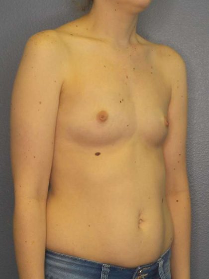 Breast Augmentation Before & After Patient #4925