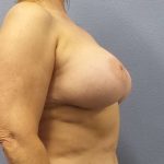 Breast Lift with Implant (Augmentation Mastopexy) Before & After Patient #4287