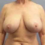 Breast Lift with Implant (Augmentation Mastopexy) Before & After Patient #4287