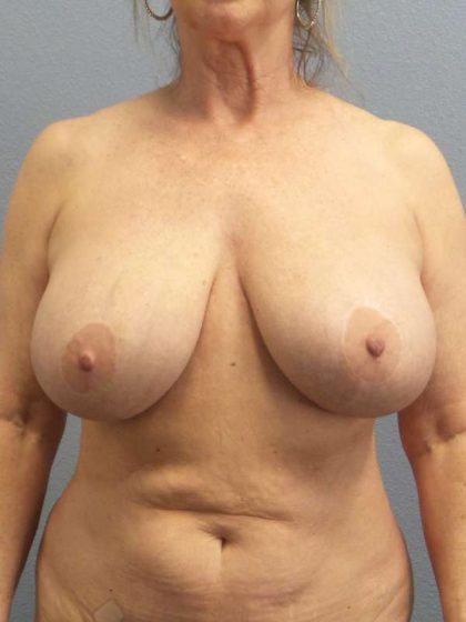 Breast Lift with Implant (Augmentation Mastopexy) Before & After Patient #4287