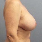 Breast Lift with Implant (Augmentation Mastopexy) Before & After Patient #4287