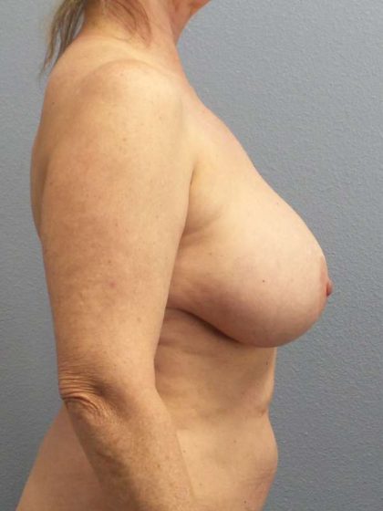 Breast Lift with Implant (Augmentation Mastopexy) Before & After Patient #4287